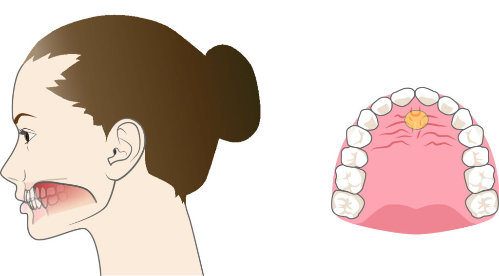 正しい舌の位置と姿勢を整えるポイント
